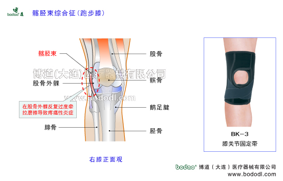 髂胫束综合征跑步膝的发病原因与防护治疗，博道膝关节固定带BK-3伸膝装置矫正固定支具，髂胫束综合症矫正固定与防护，髂胫束矫正带专用护膝，髂胫束综合征的症状与治疗，博道保暖运护膝，股骨外髁髂胫束的构造与功能，股四头肌腱膝关节囊，髂胫束在大腿外侧浅层可稳定髋关节和膝关节，因疲劳牵拉磨擦导致髂胫束和滑囊炎症肿胀疼痛结缔化即髂胫束综合征ITBS。膝内翻足内翻内八字脚骨盆倾斜或髋部外展肌股四头肌腘绳肌肌力薄弱