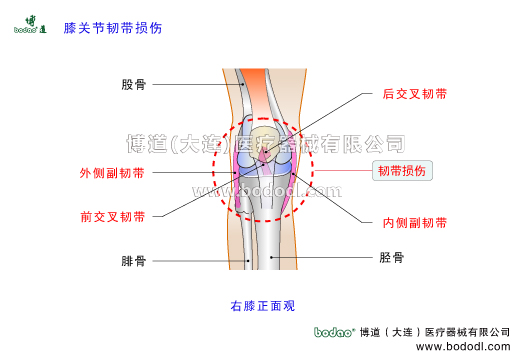 膝关节韧带损伤膝关节韧带的构造与作用内侧副韧带MCL外侧副韧带LCL前后交叉韧带前后十字韧带ACL损伤PCL损伤。博道膝关节固定带医用护膝膝关节角度可调式卡盘固定支架膝关节韧带撕脱性骨折固定夹板透气性加压护膝。膝关节韧带是膝关节重要稳定因素具有限制和制导功能当韧带承受的应力超过其完全断裂的屈服点后则发生韧带部分断裂完全断裂和联合性损伤等撕裂损伤韧带损伤类型和部位撕脱性骨折。