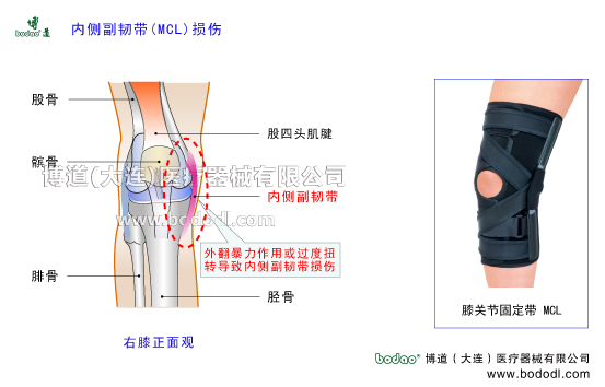 膝关节内侧副韧带MCL的构造与功能，膝内侧副韧带损伤的原因与康复治疗，博道膝关节软组织损伤固定矫正支架O型膝内翻X型腿膝外翻矫正固定护膝哪个好，膝关节内侧外侧半月板损伤断裂固定护膝，半月板损伤断裂治疗与术后固定。博道内侧副韧带MCL固定带MCL加压护膝排行榜，膝关节MCL损伤术后固定与康复护理，MCL内侧副韧带损伤防护固定夹板MCL内侧副韧带重建固定矫正支架，内侧副韧带损伤可调节式固定护膝夹板哪个好