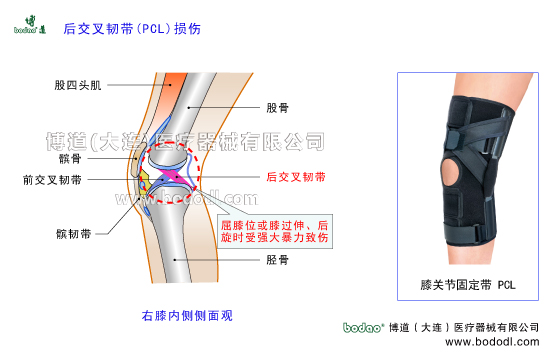膝关节后交叉韧带PCL的构造与功能。后交叉韧带损伤的原因、症状及治疗方法。博道后交叉韧带损伤加压固定带日本透气护膝膝关节PCL后交叉韧带损伤断裂的主要症状与康复治疗。可调式膝关节韧带固定支架膝关节软组织损伤固定夹板膝关节增生性关节炎膝关节损伤的防护与术后固定护理博道透气性加压护膝后十字韧带损伤医用固定带PCL损伤固定带膝关节的构造PCL后交叉韧带后十字韧带重建固定膝关节疾病的预防与治疗膝关节疾病的治