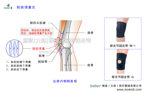 髌前滑囊炎膝关节滑囊炎的病因症状及防护与治疗。膝关节滑囊的构造与功能作用。博道膝关节透气性加压固定带的功能与防护效果，医用加压护膝，滑囊炎专用加压固定护膝，透气性保暖保健护膝。右膝内侧侧面观膝关节的构造。股四头肌腱髌前滑囊髌韧带髌前肌腱下滑囊髌前筋膜下滑囊髌前皮下滑囊。医用护膝BK-1透气性膝关节固定带CL-1可调式膝关节卡盘固定支架矫形支具膝关节术后康复固定夹板膝关节共有11个滑囊是全身关节中滑囊
