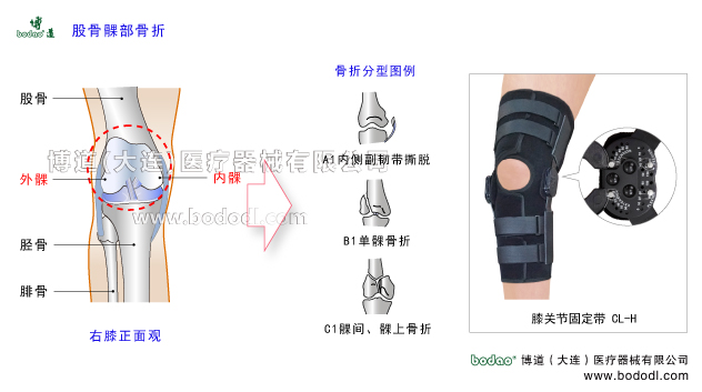 股骨髁部骨折，膝关节的结构，博道角度可调式卡盘固定支架，膝关节内骨折的分类及特点，博道医用护膝CL-H股骨髁部骨折的原因、症状与术后治疗固定支架，膝关节股骨骨折的原因、症状、分型与康复治疗。膝关节置换固定支架腿部下肢骨折固定夹板，膝关节损伤固定支具。膝关节区域骨折专业固定支架、膝关节韧带重建术后固定带、股骨髁部骨折危害胫骨平台和髌股关节改变膝关节正常的解剖轴与机械轴，导致伸膝装置粘连、创伤性膝关节炎