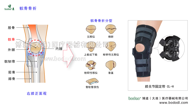 髌骨骨折。膝关节区域骨折角度可调式卡盘固定支架，博道医用CL-H膝关节固定带膝关节损伤固定夹板，股骨髁部髌骨胫骨平台骨折固定支架。髌骨的构造及髌骨骨折的原因、分型、症状与康复治疗。膝关节置换固定支具腿部下肢骨折CL-H固定夹板，膝关节软组织损伤康复固定支具，膝关节韧带重建术后固定带膝关节外伤术后固定康复护理。髌骨是人体最大的籽骨，髌骨背面为关节软骨面与股骨髌面形成髌股关节髌骨与股四头肌及其肌腱髌韧带