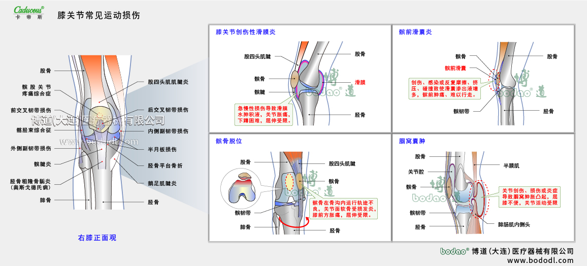 膝关节运动损伤的类型与症状