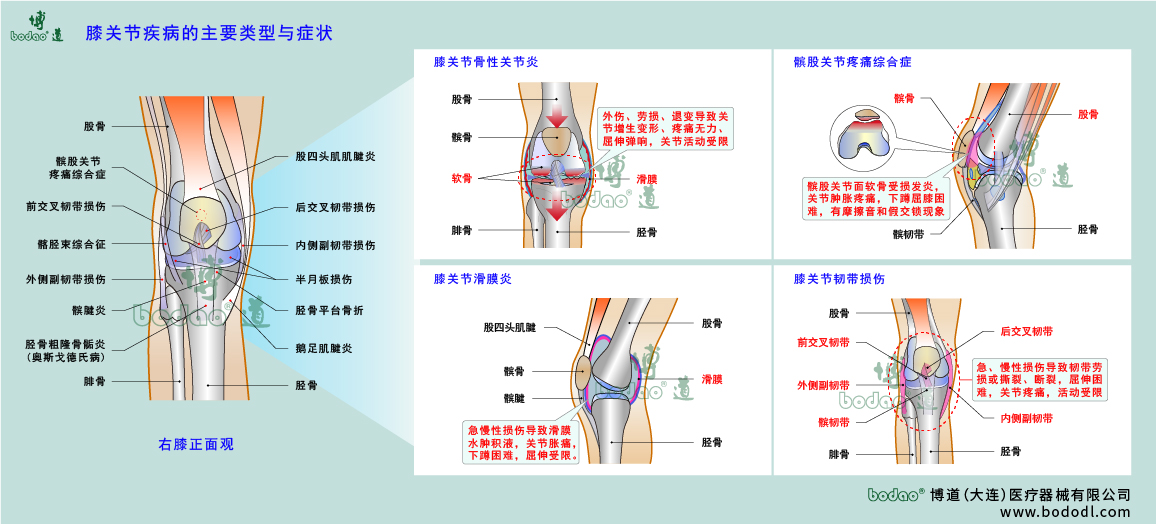 膝关节疾病的类型与症状